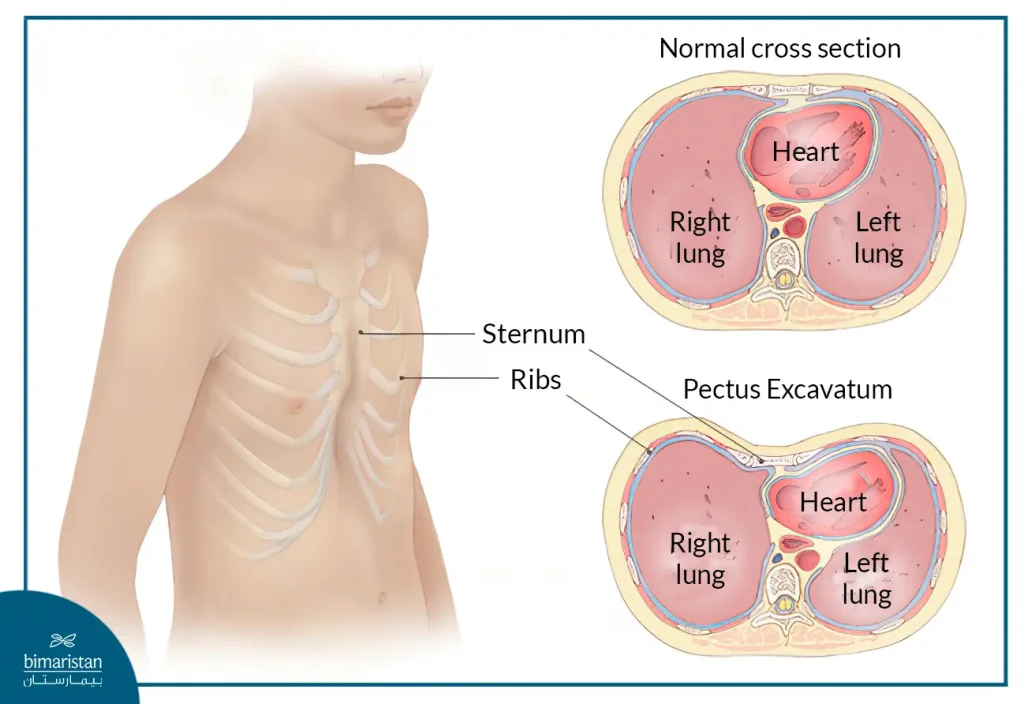 Comparison Between The Natural Shape Of The Chest Cage And The Shape Of Pectus Excavatum - Pectus Excavatum Deformity In Pictures