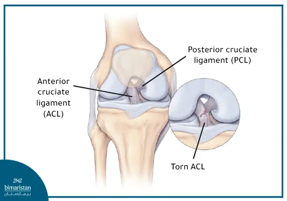 The Anterior Cruciate Ligament (Acl) Tear - Diagram Of A Torn Anterior Cruciate Ligament.