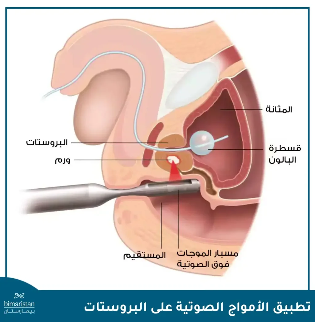 علاج سرطان البروستاتا بالموجات فوق الصوتية: تقنية آمنة لاستهداف الورم بدقة 2 علاج سرطان البروستاتا بالموجات فوق الصوتية