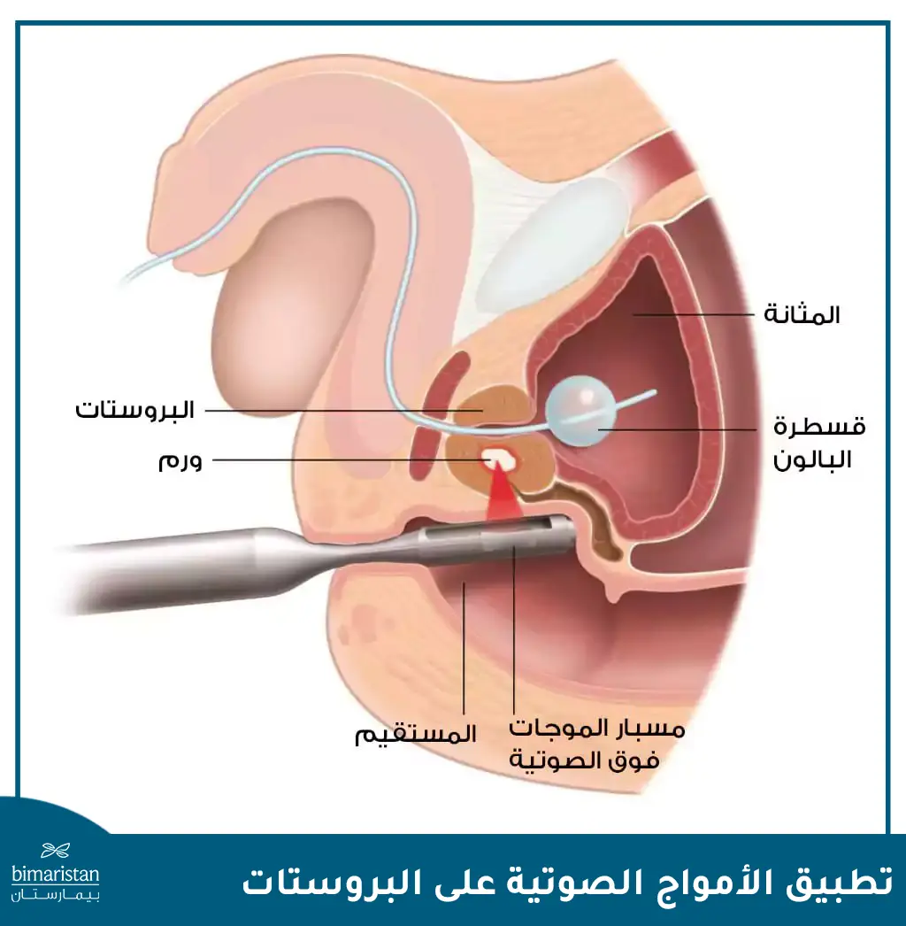 علاج سرطان البروستاتا بالموجات فوق الصوتية