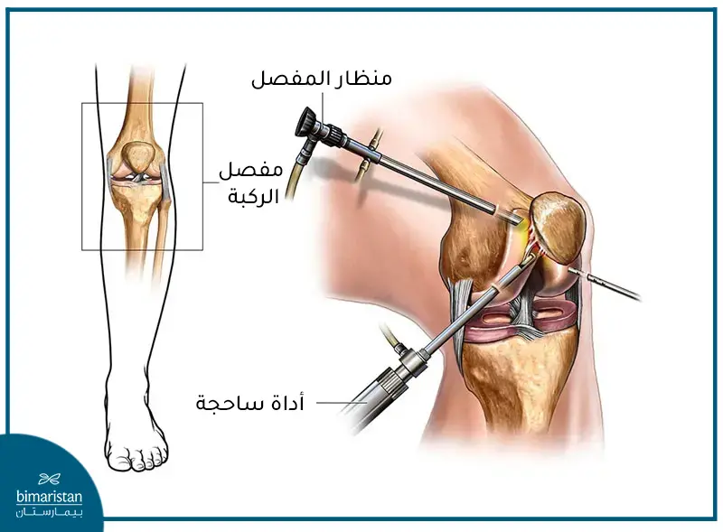 عمليات الرباط الصليبي بالمنظار في تركيا