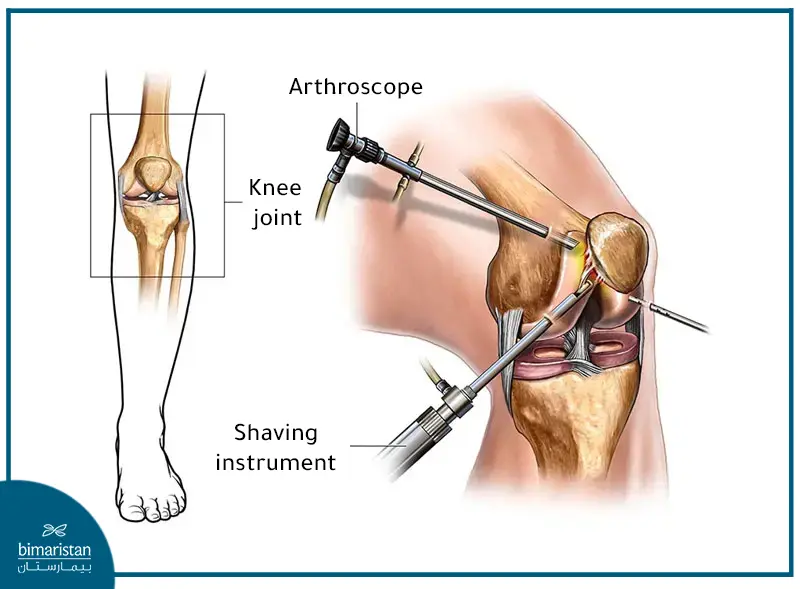 Arthroscopic Acl Surgeries In Turkey.
