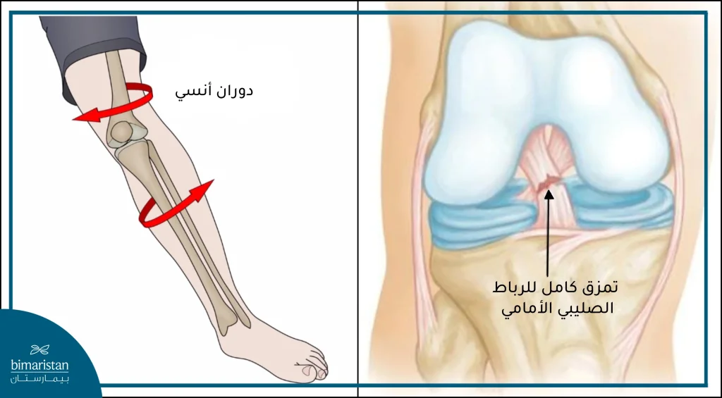 الدوران الأنسي المفاجئ للركبة أحد أسباب تمزق الرباط الصليبي الأمامي