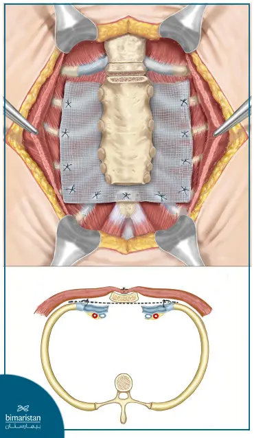 Treatment Of Pectus Excavatum In Turkey