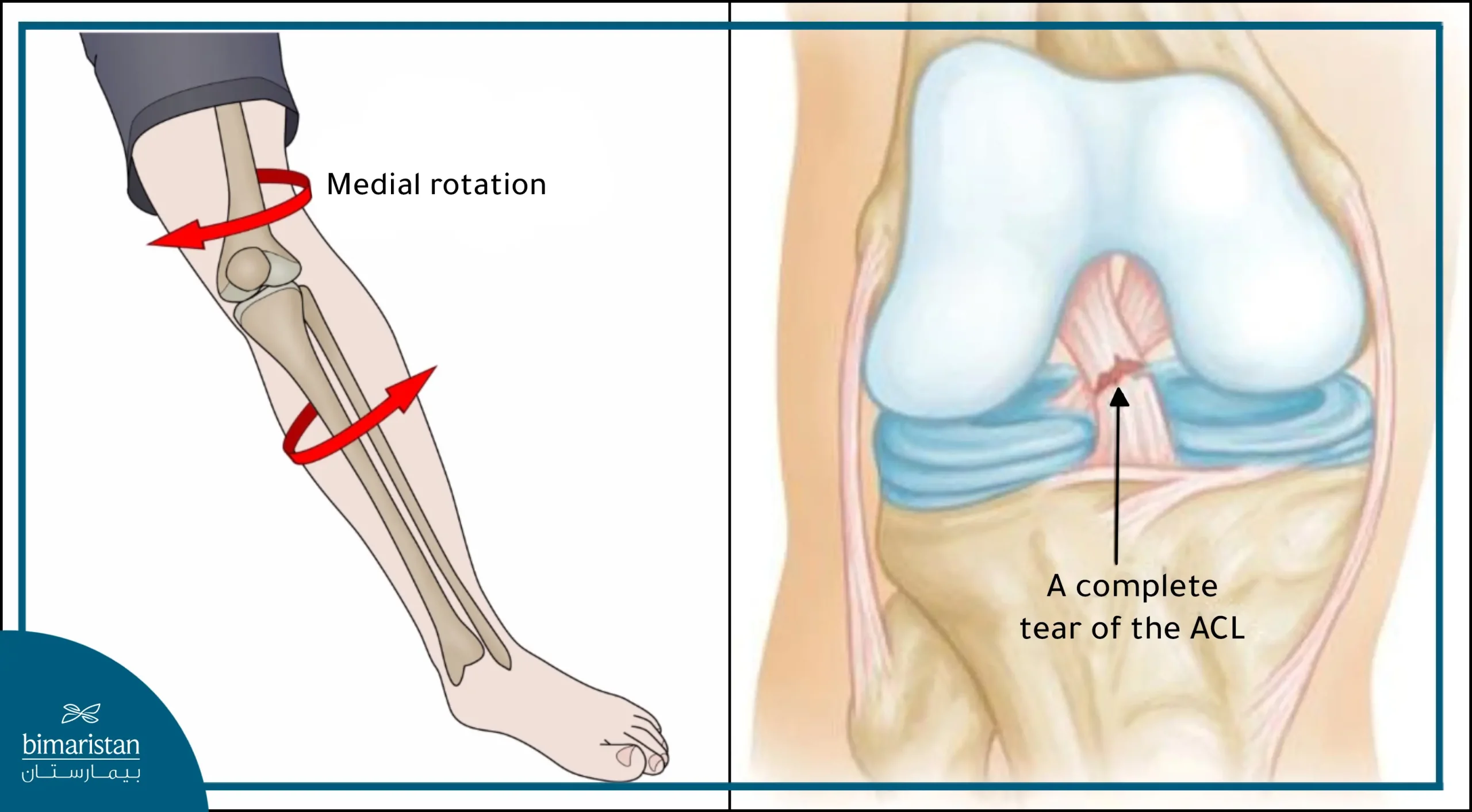 Sudden Rotational Movement Of The Knee Is One Of The Causes Of Anterior Cruciate Ligament (Acl) Tear.