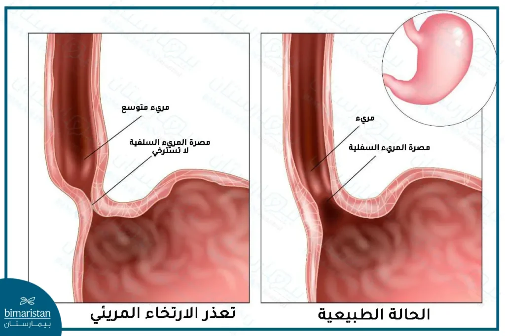 مرض تعذر الارتخاء المريئي (الاكاليزيا) والمري الطبيعي