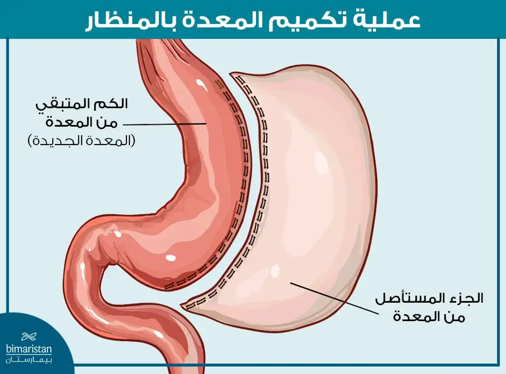 يتم خلال عملية تكميم المعدة في تركيا تصغير حجم المعده وإزالة قسم كبير منها