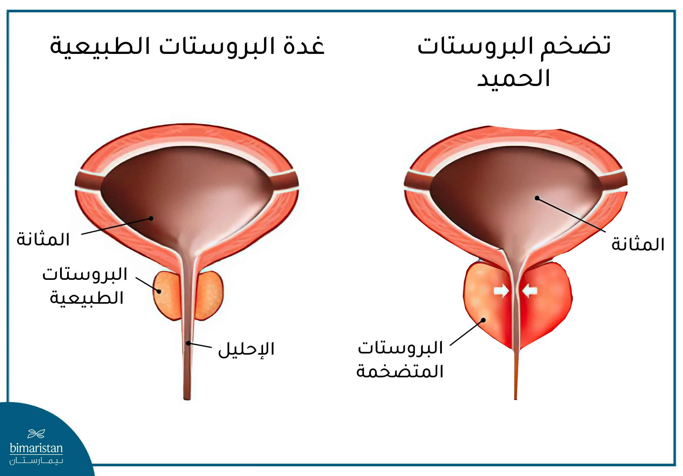 صورة تظهر مقارنة بين غدة البروستاتا الطبيعية وحالة تضخم البروستات الحميد (Bph) والتي يمكن تدبيرها عبر عملية تبخير البروستاتا