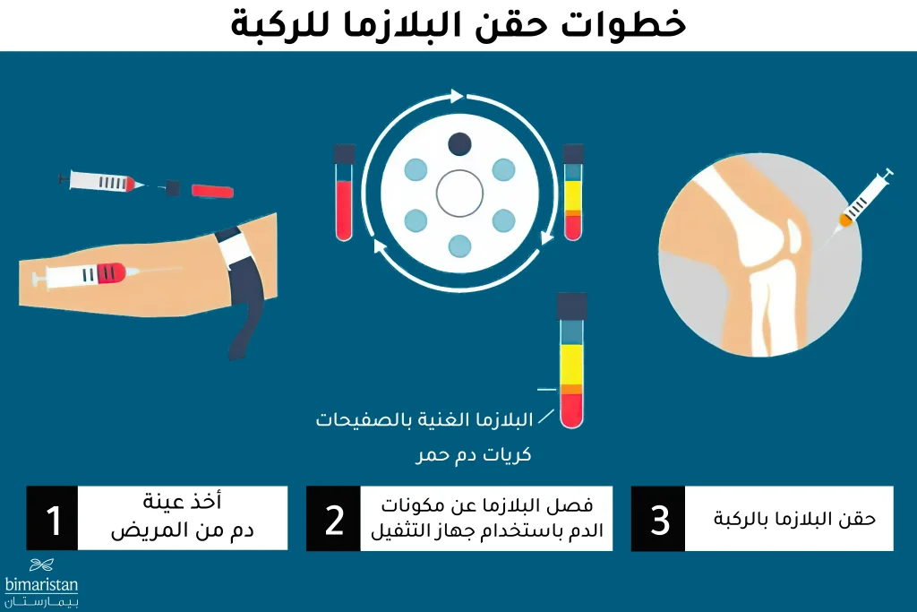 كيفية حقن البلازما للركبة