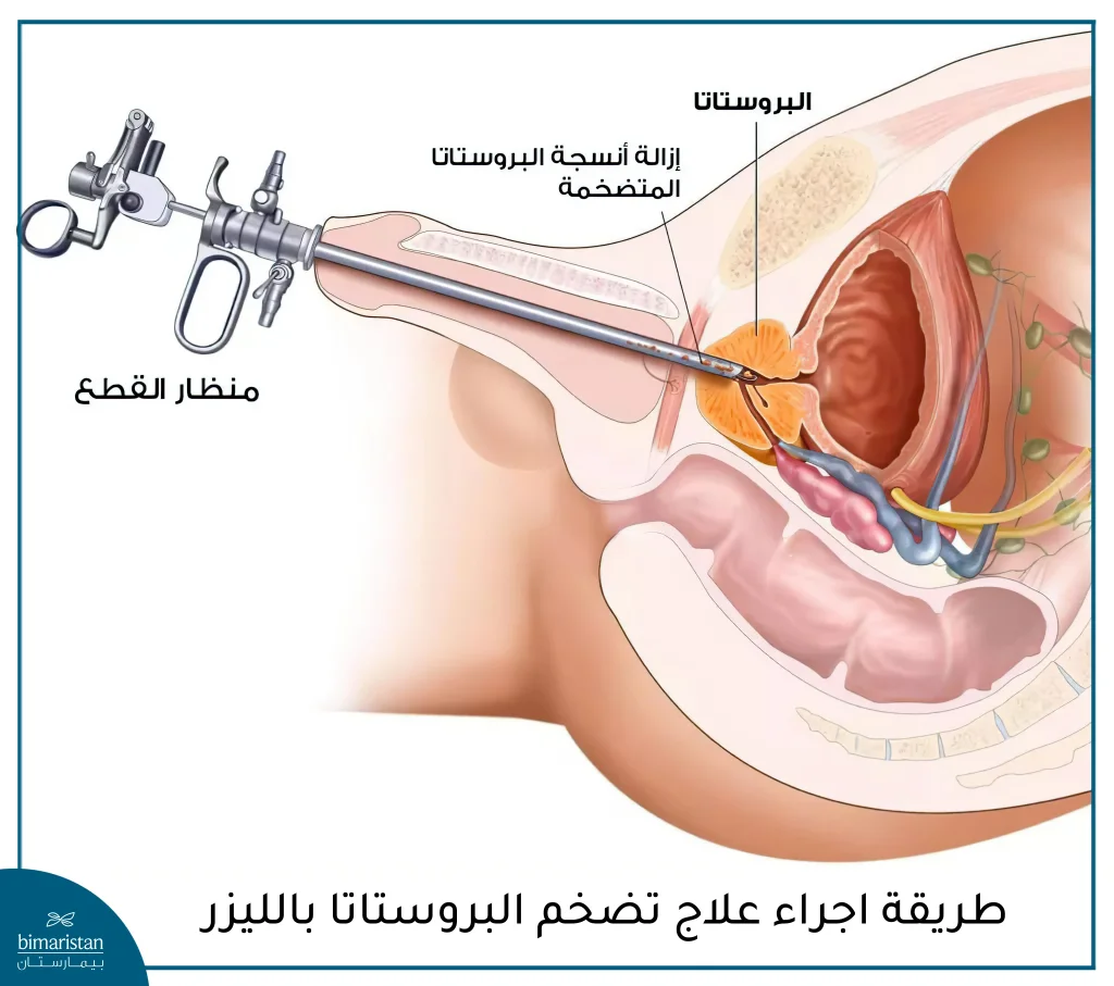 طريقة إجراء علاج تضخم البروستاتا بالليزر في تركيا