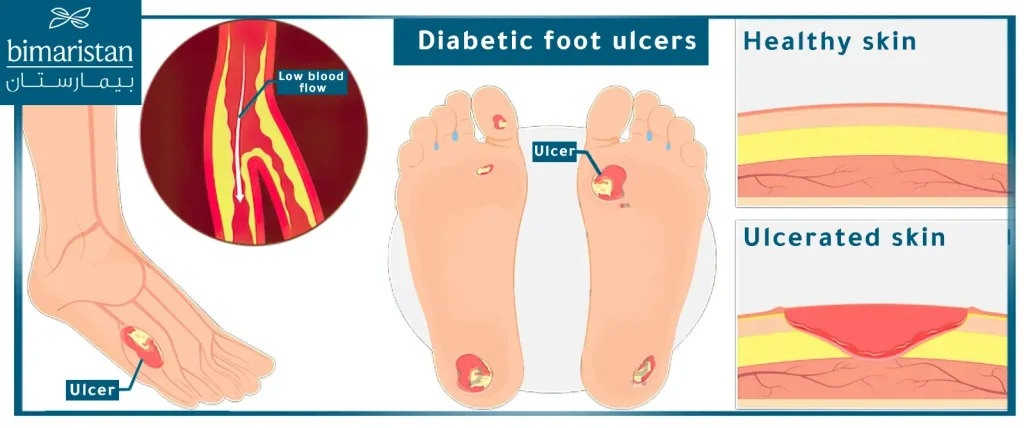 Vascular Occlusion As A Cause Of Diabetic Foot