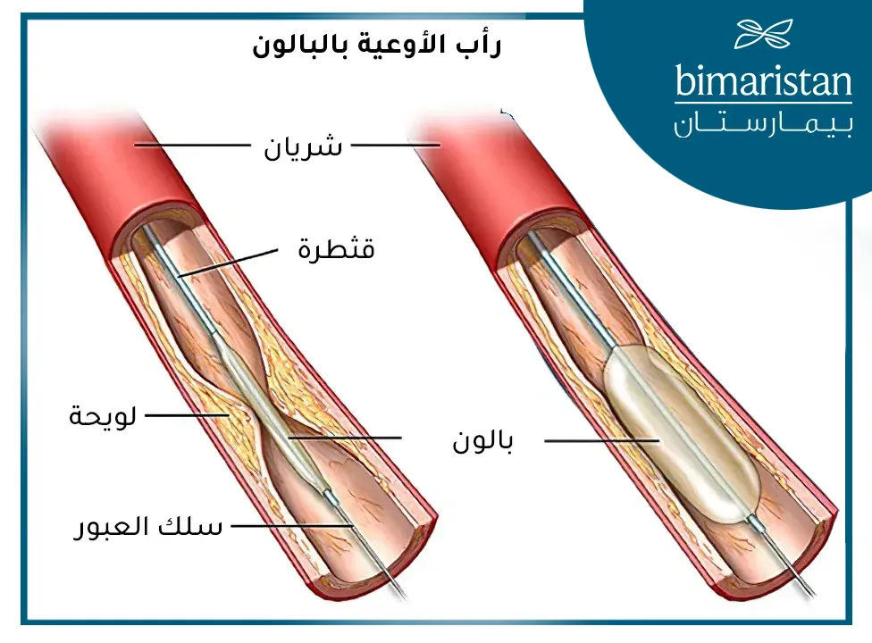 رأب الأوعية الدموية بالبالون - أحدث علاج القدم السكري في تركيا