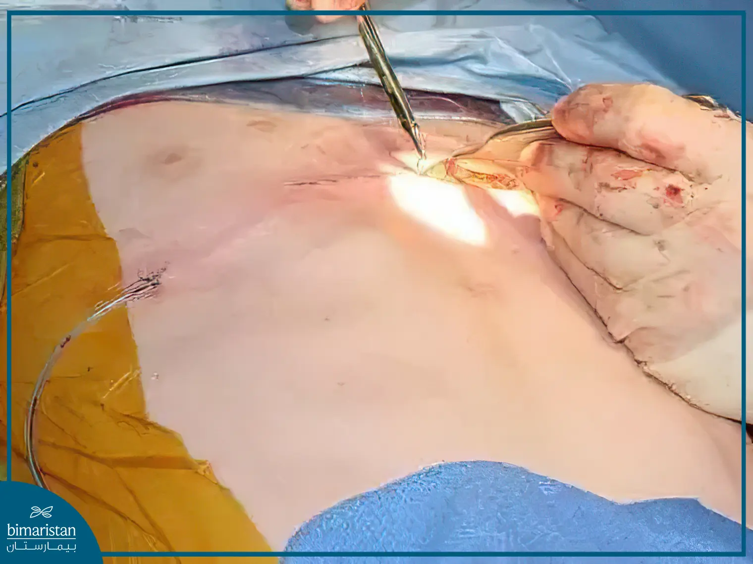 Surgical Treatment Of Pectus Carinatum In Turkey