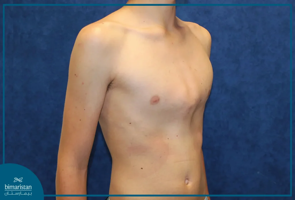 The Shape Of The Protrusion Of The Sternum
