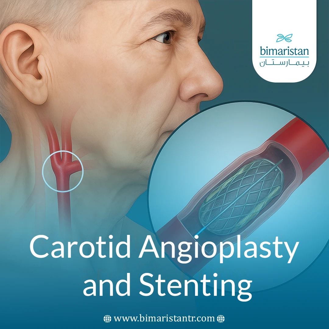 Carotid Angioplasty And Stenting