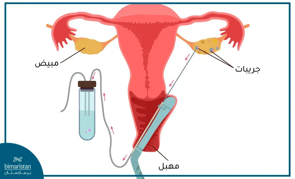 خطوات التلقيح الصناعي بالصور