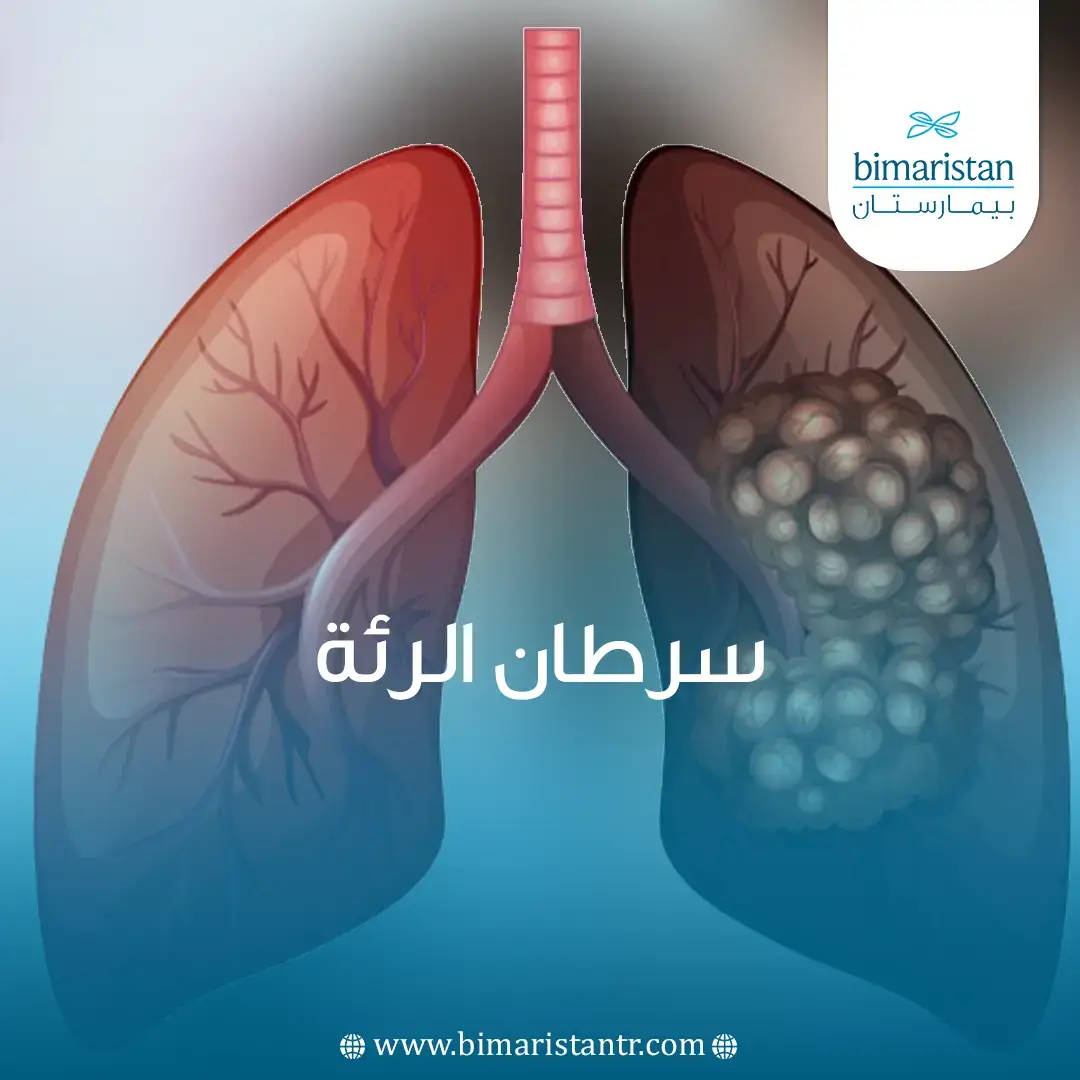 صورة غلاف لمقالة سرطان الرئة