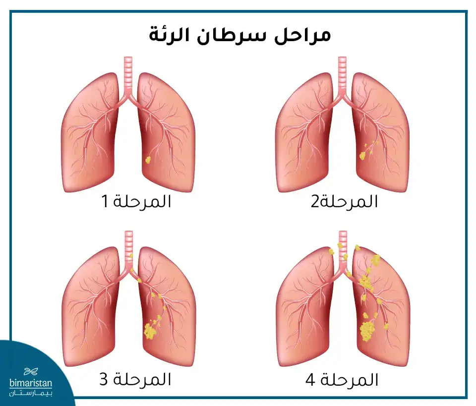 مراحل الورم الخبيث في الرئة