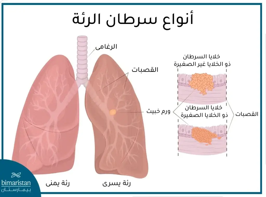 أنواع سرطان الرئة