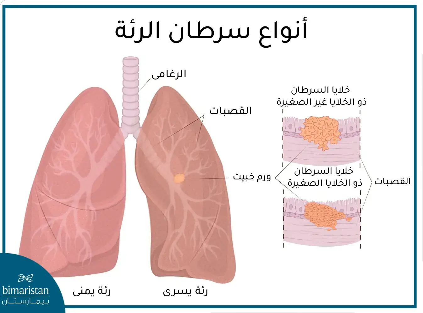 أنواع السرطان في الرئة