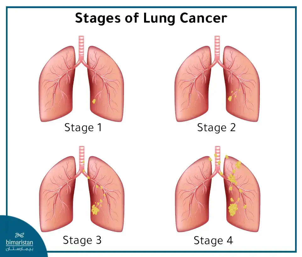 Lung Cancer Stages