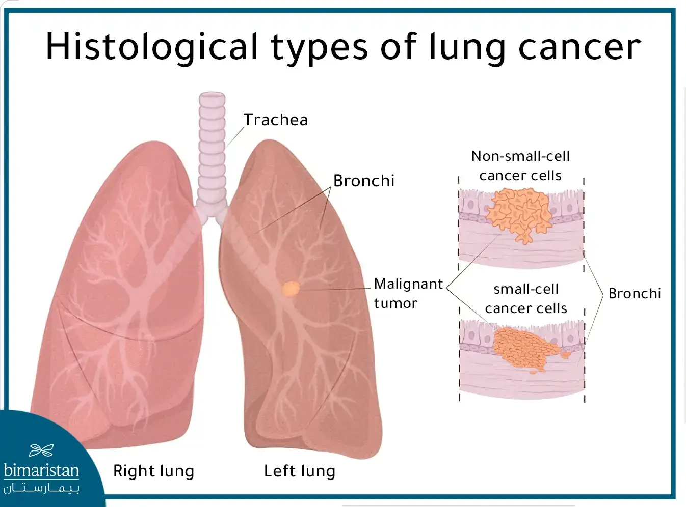 Lung Cancer Types