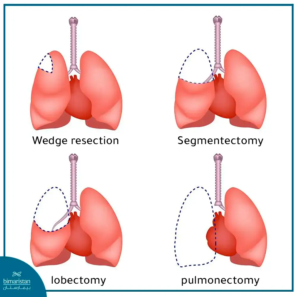 Types Of Lung Cancer Surgery