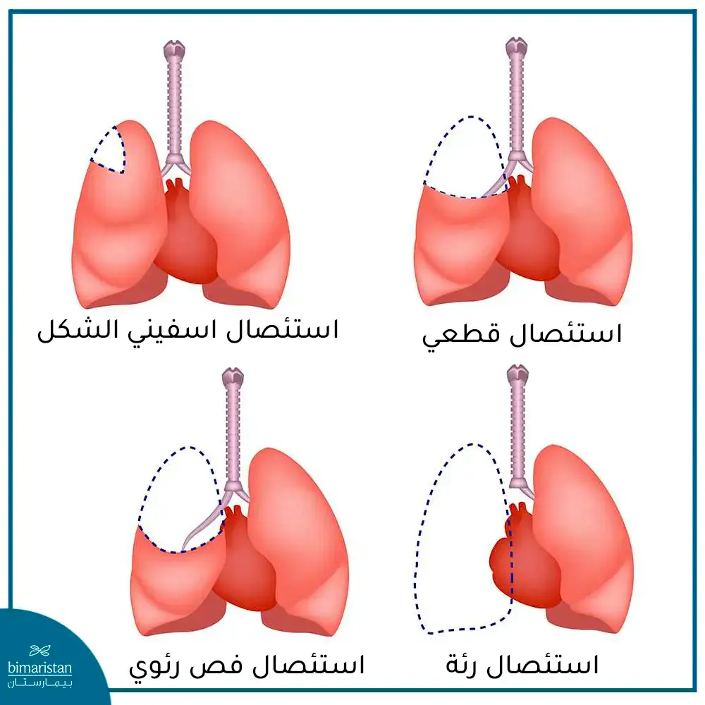 أنواع جراحة سرطان الرئة