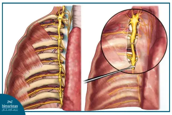 Sympathectomy Surgery - The Best Treatment For Excessive Sweating