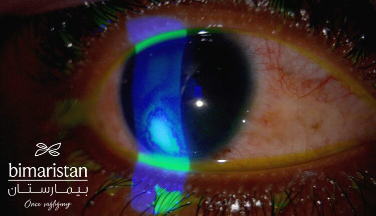 An Image Illustrating Corneal Abrasion