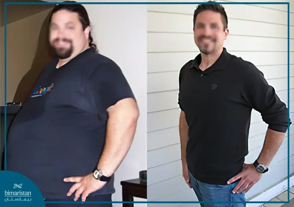 An Image Of A Patient Before Gastric Sleeve Surgery In Turkey And After Several Months Post-Surgery.