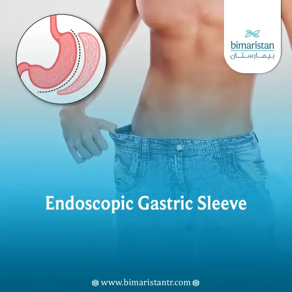 Gastric Sleeve