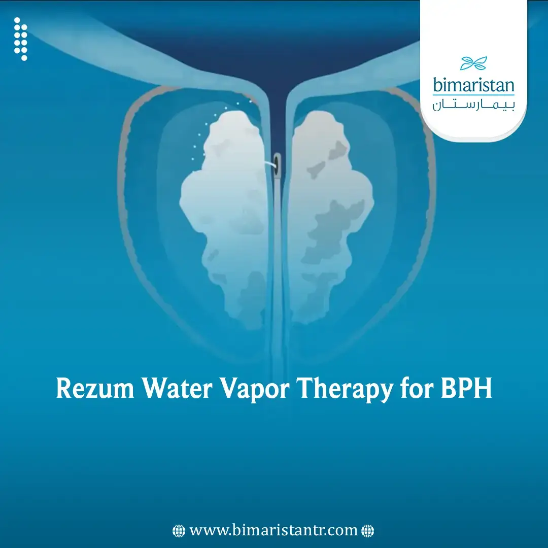 Rezum Therapy For Bph