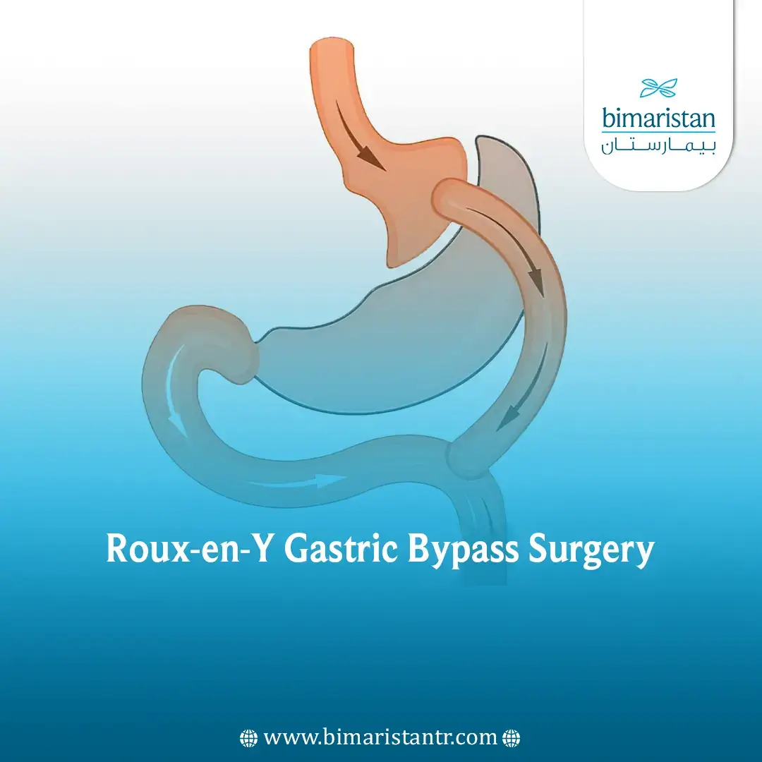 Roux-En-Y Gastric Bypass Surgery