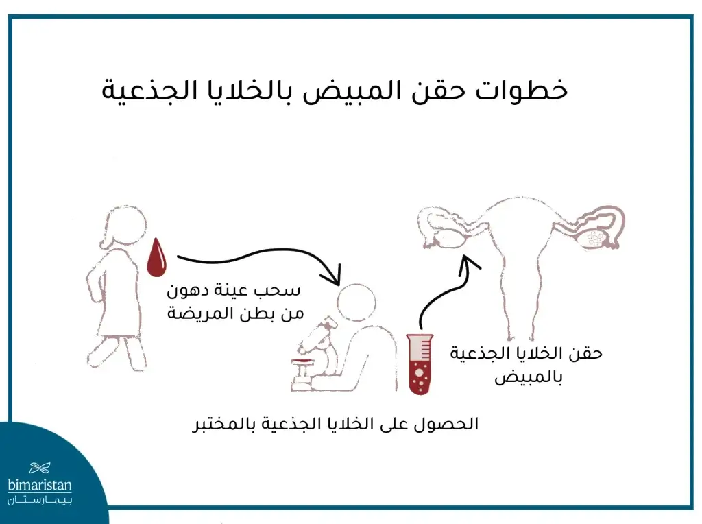 خطوات حقن المبيض بالخلايا الجذعية في تركيا