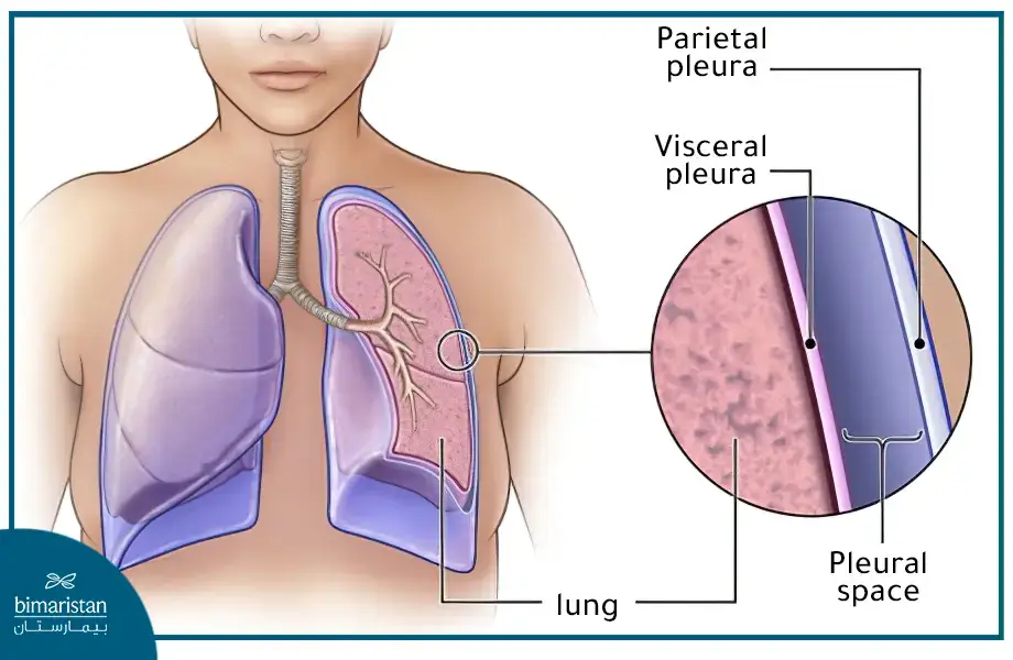 Pleural Effusion: Types And Treatment Options 3 The Shape Of The Pleura That Surrounds The Lung