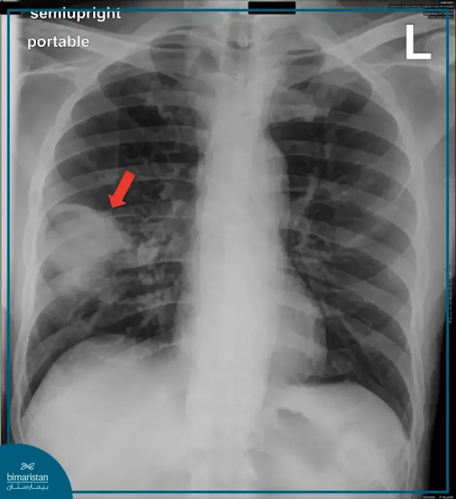 Lung Abscess Treatment: Removal &Amp; Prevention Guide 3 Chest X-Ray (Cxr) Reveals An Abscess In The Right Lung.
