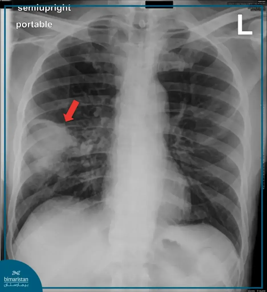شكل خراج الرئة بالصورة الشعاعية البسيطة للصدر