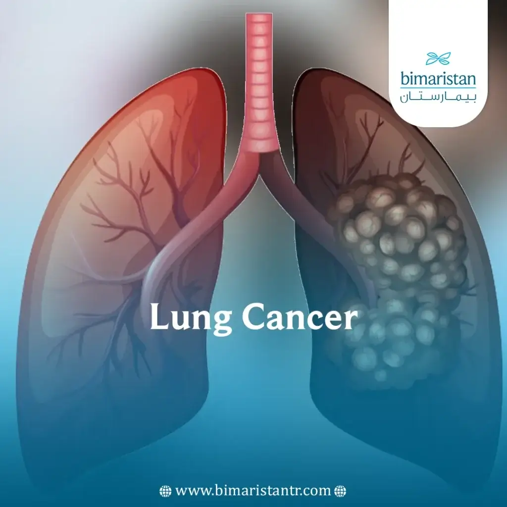 Cover Image For Lung Cancer Article