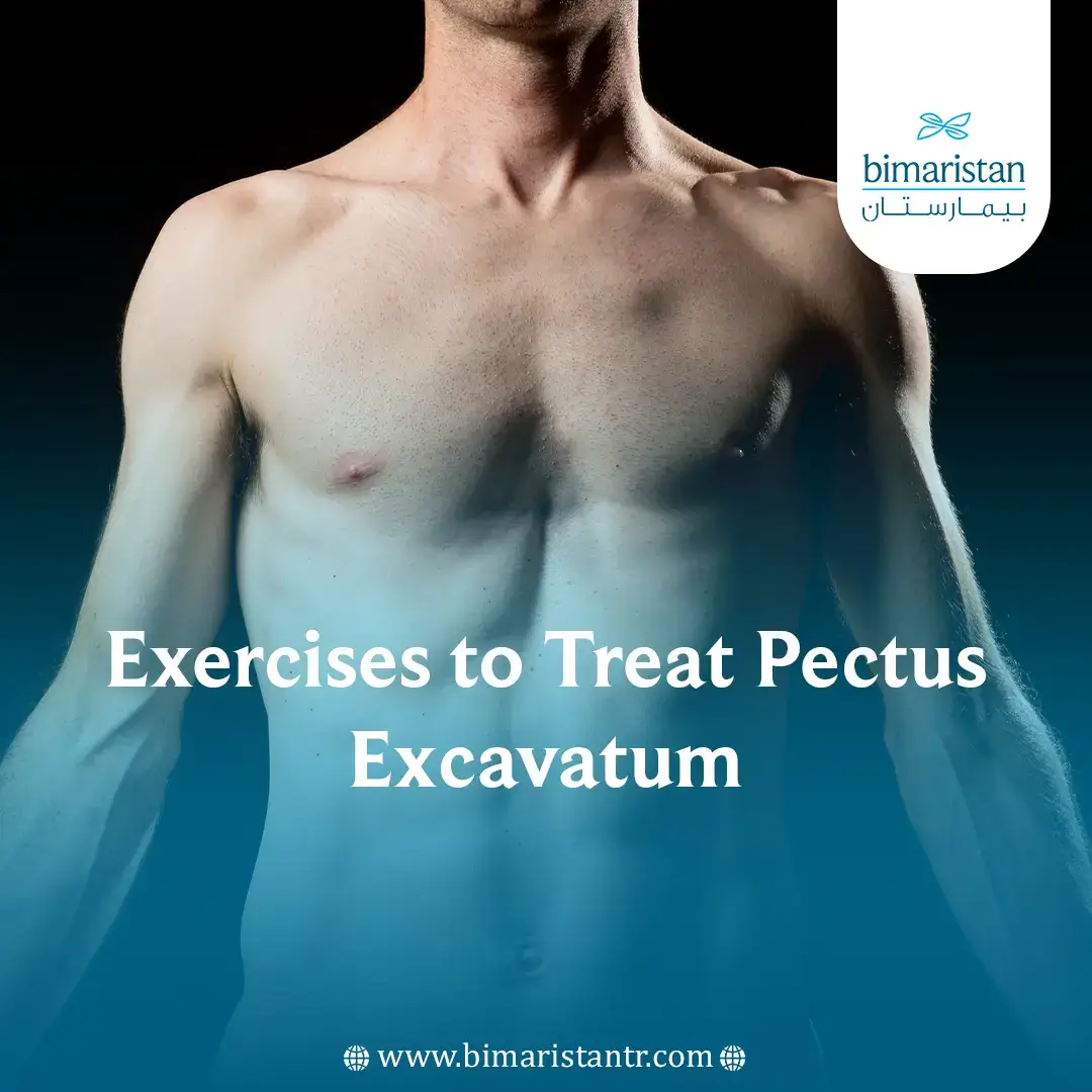 Exercises To Treat Pectus Excavatum