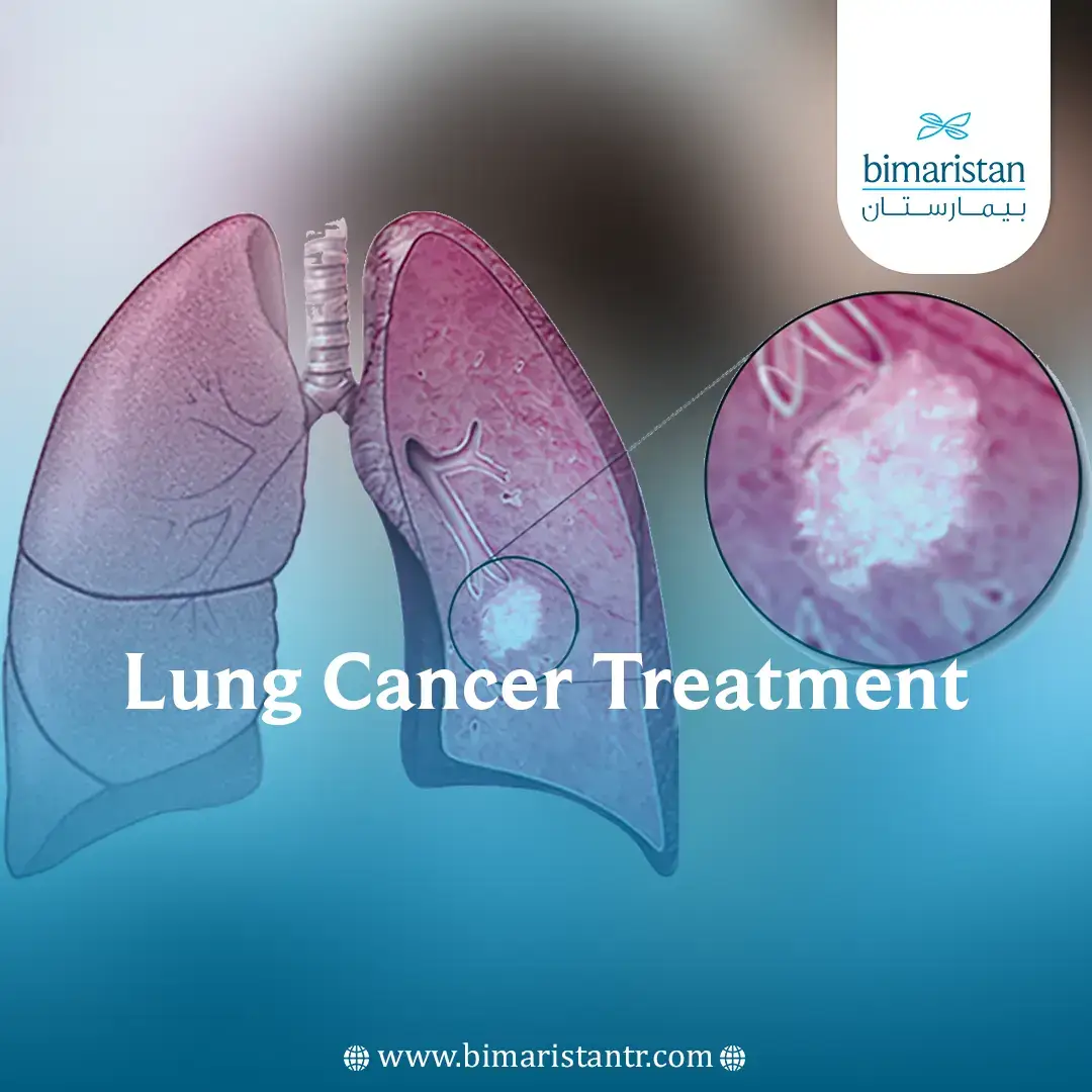 Cover Image For Lung Cancer Treatment Article