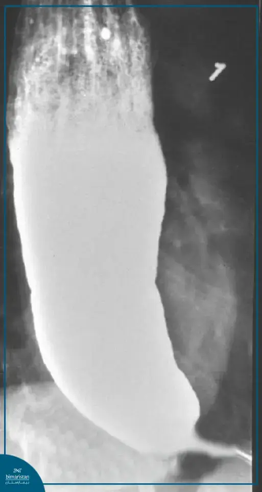 An X-Ray Of The Esophagus With A Radioactive Barium Swallow. In This Image, We Find A Large Dilatation Of The Esophagus With A Narrowing Of Its Lower End, Which Takes The Shape Of A Bird’s Beak. This Is A Characteristic Manifestation Of Esophageal Achalasia