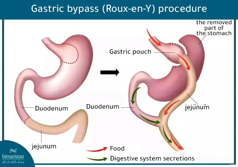 The Shape Of The Stomach And Intestines After A Roux-En-Y Gastric Bypass Surgery.