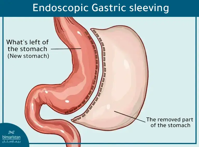 The Shape Of The Stomach After Undergoing Gastric Sleeve Surgery In Turkey Using Laparoscopy.