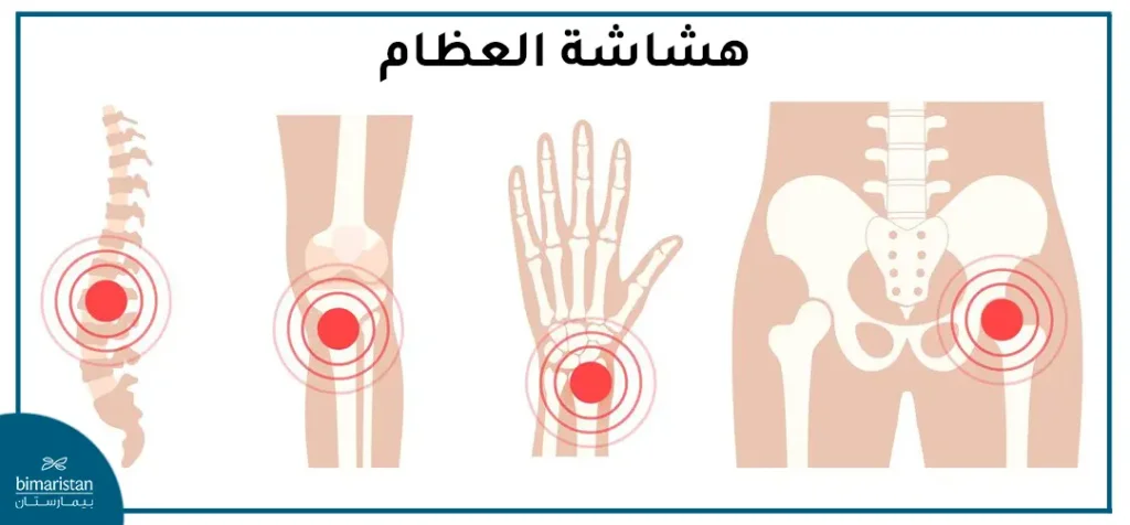 المفاصل التي يحدث فيها كسور نتيجة هشاشة العظام