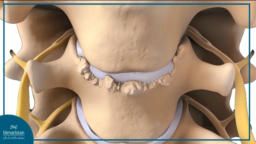 Shape Of Cervical Bone Spurs