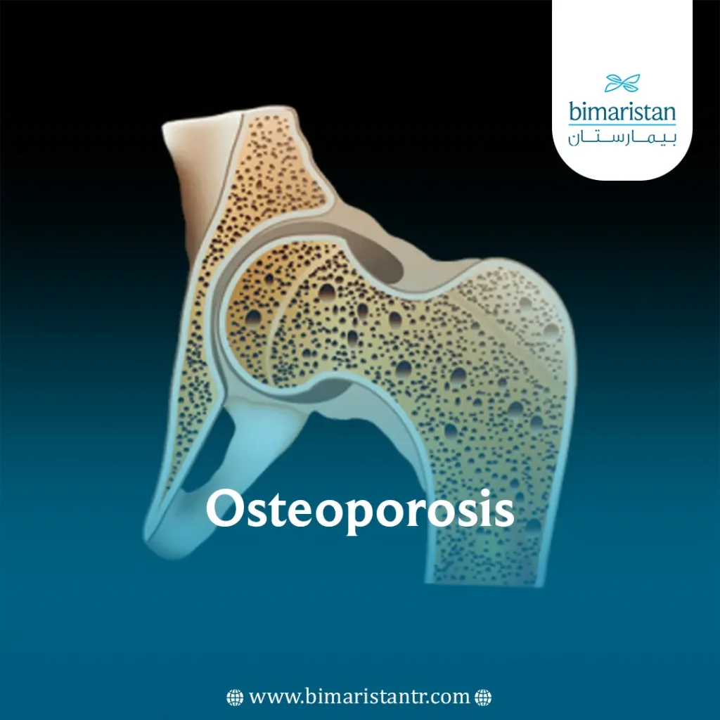 Osteoporosis