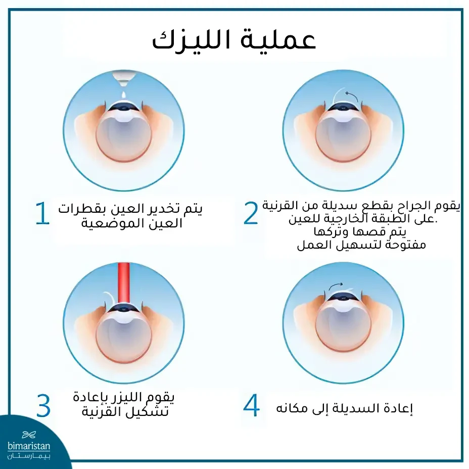 خطوات عملية الليزك للعين