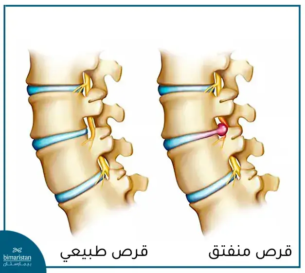 القرص المنفتق