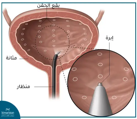 علاج التهاب المثانة المزمن عند النساء بواسطة حقن البوتوكس في جدار المثانة